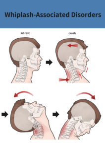 Medical illustration for explanation Whiplash-Associated Disorders